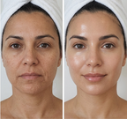 Before and after comparison of a woman's face with a towel on her head.