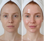 Before and after comparison of a woman's face with a towel on her head, showing skin treatment.